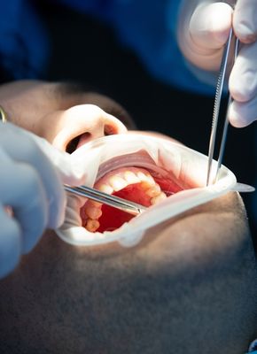apple dent root canal treatment