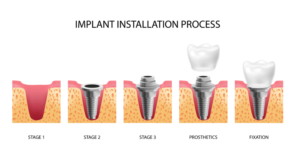 dental implants